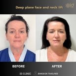 Before and after deep plane facelift and neck lift results at ID Clinic Bangkok