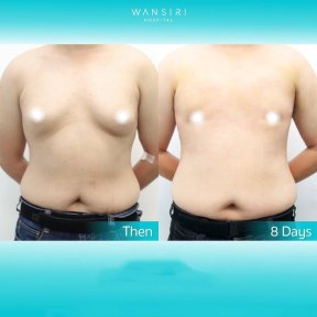 Before and after liposuction for gynecomastia at Wansiri Hospital, chest contour results