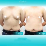 Before and after liposuction for gynecomastia at Wansiri Hospital, chest contour results