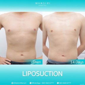 Before and after liposuction for gynecomastia at Wansiri Hospital, visible chest contour result