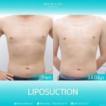 Before and after liposuction for gynecomastia at Wansiri Hospital, visible chest contour result