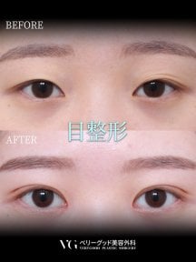 Résultats avant/après blépharoplastie chez VG Plastic Surgery, création double paupière