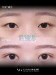 Résultats avant/après blépharoplastie chez VG Plastic Surgery, création double paupière