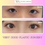 Résultats avant/après blépharoplastie chez VG Plastic Surgery, amélioration naturelle des yeux