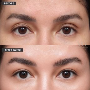 Résultats avant/après deep plane facelift chez VG Plastic Surgery, rajeunissement du regard
