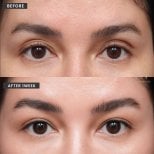 Résultats avant/après deep plane facelift chez VG Plastic Surgery, rajeunissement du regard