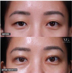 Résultat avant/après deep plane facelift chez VG Plastic Surgery, rajeunissement du regard