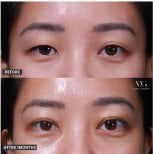 Résultat avant/après deep plane facelift chez VG Plastic Surgery, rajeunissement du regard