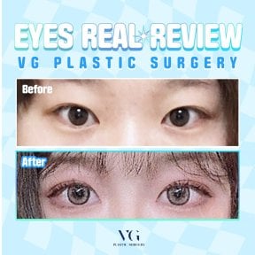 Résultats avant et après blépharoplastie chez VG Plastic Surgery – regard amélioré