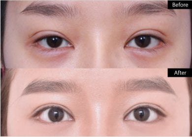 Résultats avant/après blépharoplastie chez VG Plastic Surgery, regard amélioré