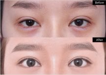 Résultats avant/après blépharoplastie chez VG Plastic Surgery, regard amélioré