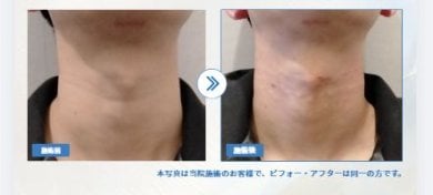 Before and after fillers injection result for neck contouring at Forena Clinic