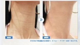 Before and after fillers injection at Forena Clinic, neck wrinkle reduction result