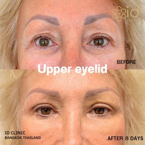 Before and after upper eyelid surgery results at ID Clinic Bangkok, 8 days post-procedure