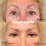 Before and after upper eyelid surgery results at ID Clinic Bangkok, 8 days post-procedure