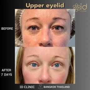 Before and after upper eyelid surgery results at ID Clinic Bangkok, 7 days post-procedure