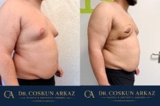 Vorher-nachher-Ergebnisse der Gynäkomastie-OP in der Zarina Clinic – bessere Brustkontur