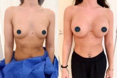 Vorher-nachher-Ergebnis Brustvergrößerung in der Zarina Clinic, verbesserte Form und Größe