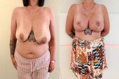 Efekty przed i po liftingu piersi z okrągłymi implantami w Zarina Clinic