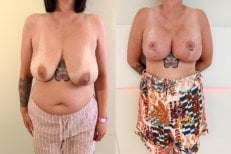 Efekty przed i po liftingu piersi z okrągłymi implantami w Zarina Clinic