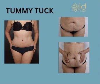 Before and after tummy tuck results at ID Clinic Bangkok, visible abdominal contour improvement