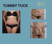 Before and after tummy tuck results at ID Clinic Bangkok, visible abdominal contour improvement