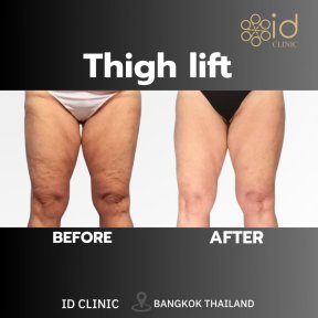 Before and after thigh lift results at ID Clinic Bangkok, improved thigh contour and firmness