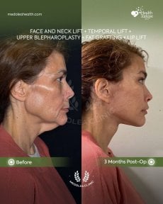 before-after photo glubokaya-podtyazhka-lica-deep-plane-facelift