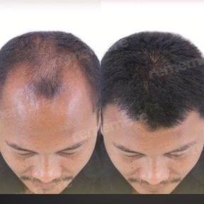 before-after photo hair-transplant