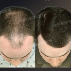 before-after photo hair-transplant