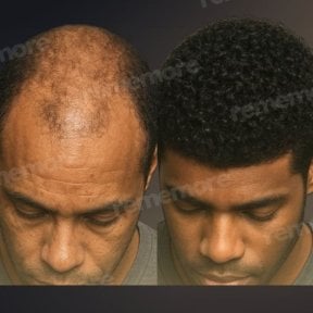 before-after photo hair-transplant