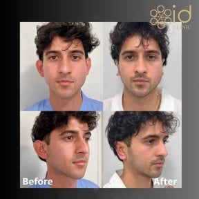 before-after photo otoplasty-ear-surgery