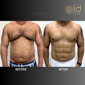 before-after photo vaser-liposuction