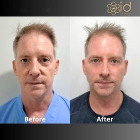 before-after photo tightening-of-facial-skin-facelift