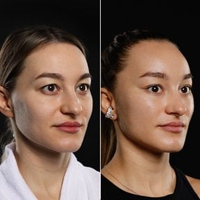 before-after photo deep-plane-facelift