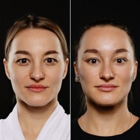 before-after photo deep-plane-facelift