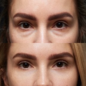 before-after photo lower-eyelid-surgery