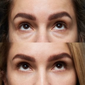 before-after photo lower-eyelid-surgery