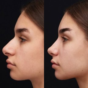before-after photo rhinoplasty-nose-job