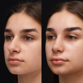 before-after photo rhinoplasty-nose-job