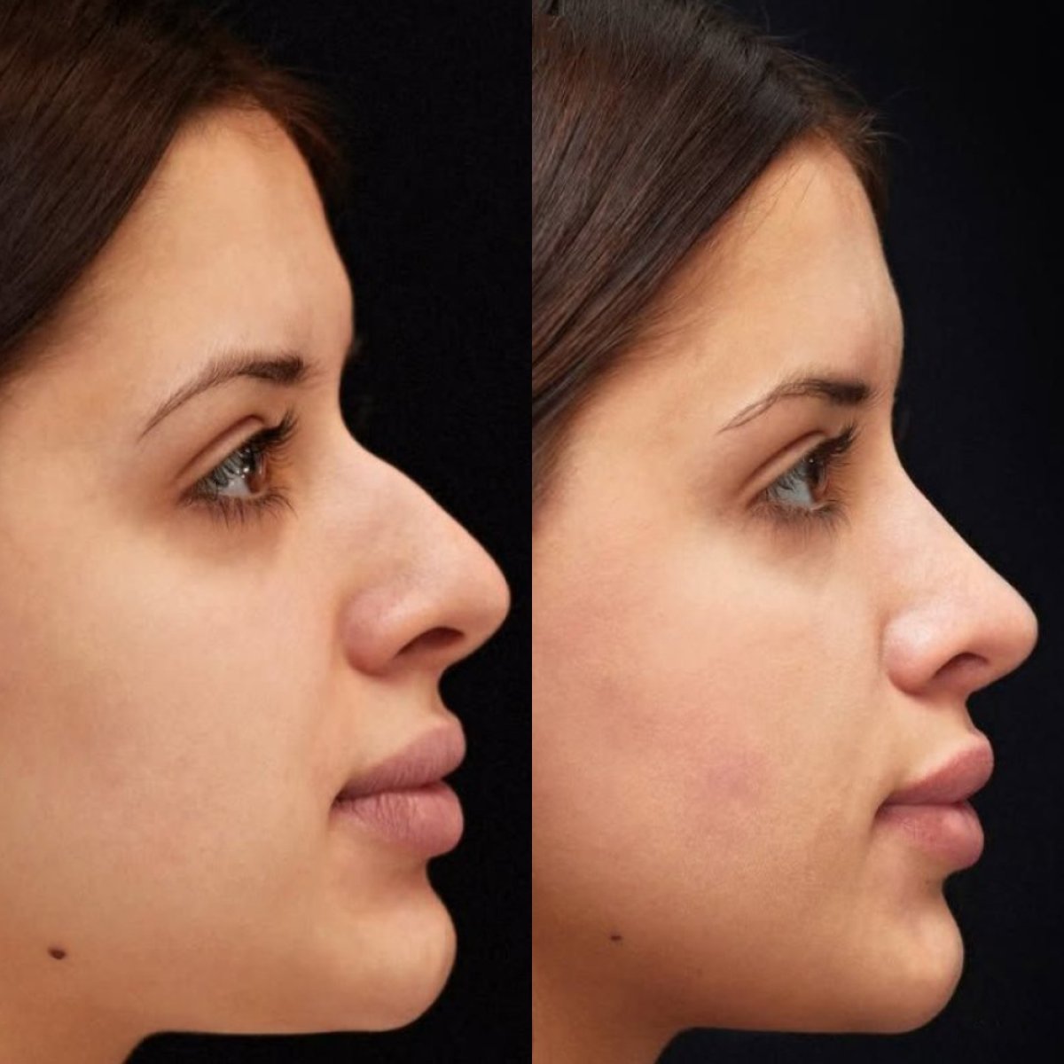 Resultados de rinoplastia antes y después en Vidnova Clinic, perfil nasal natural