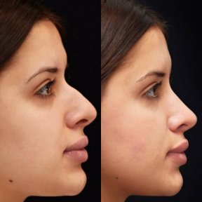 before-after photo rhinoplasty-nose-job