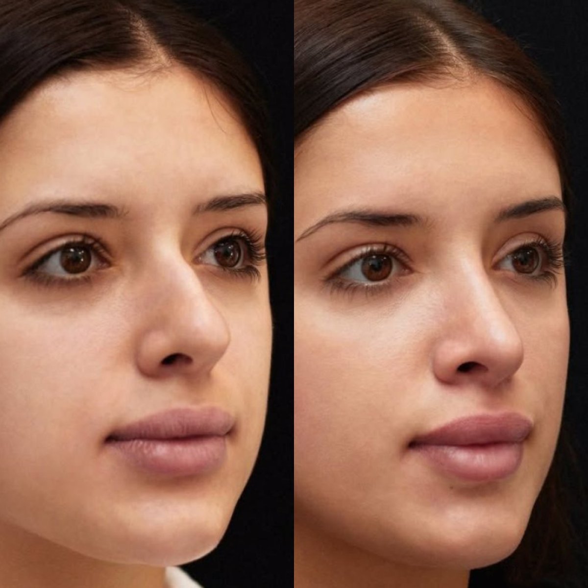 Resultados de rinoplastia antes y después en Vidnova Clinic, remodelación nasal natural