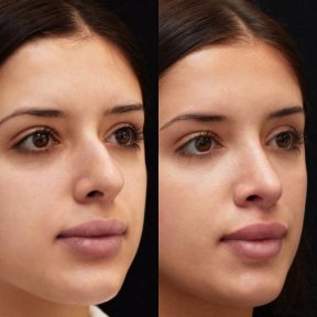 before-after photo rhinoplasty-nose-job