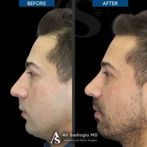 before-after photo rhinoplasty-nose-job