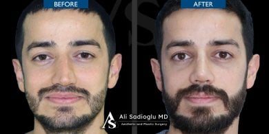before-after photo rhinoplasty-nose-job