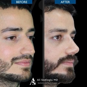 before-after photo rhinoplasty-nose-job