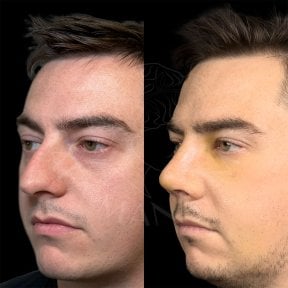 before-after photo rhinoplasty-nose-job