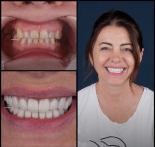 Résultat avant et après facettes dentaires à Mira Clinic, sourire naturel et éclatant