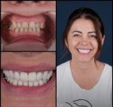 Résultat avant et après facettes dentaires à Mira Clinic, sourire naturel et éclatant